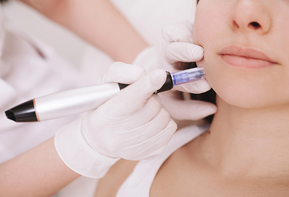 Dermapen con Vitaminas